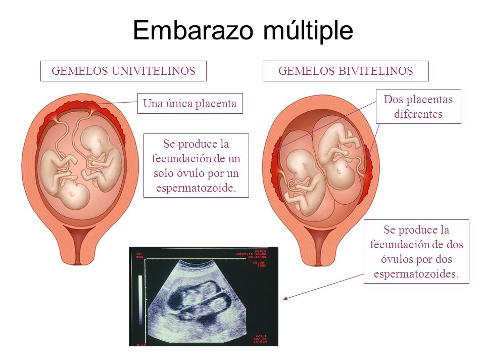 Embarazo múltiple GEMELOS UNIVITELINOS GEMELOS BIVITELINOS