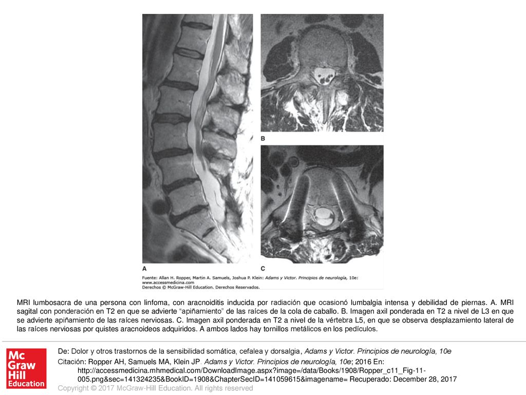 MRI lumbosacra de una persona con linfoma, con aracnoiditis inducida por radiación que ocasionó lumbalgia intensa y debilidad de piernas. A. MRI sagital con ponderación en T2 en que se advierte apiñamiento de las raíces de la cola de caballo. B. Imagen axil ponderada en T2 a nivel de L3 en que se advierte apiñamiento de las raíces nerviosas. C. Imagen axil ponderada en T2 a nivel de la vértebra L5, en que se observa desplazamiento lateral de las raíces nerviosas por quistes aracnoideos adquiridos. A ambos lados hay tornillos metálicos en los pedículos.
