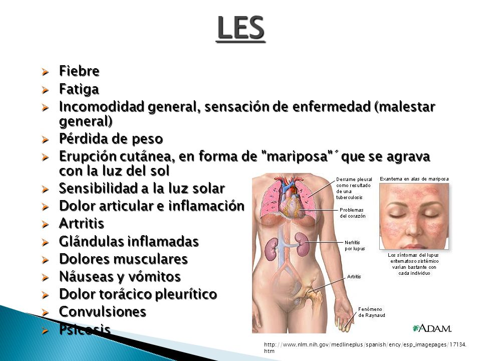 LES Fiebre. Fatiga. Incomodidad general, sensación de enfermedad (malestar general) Pérdida de peso.