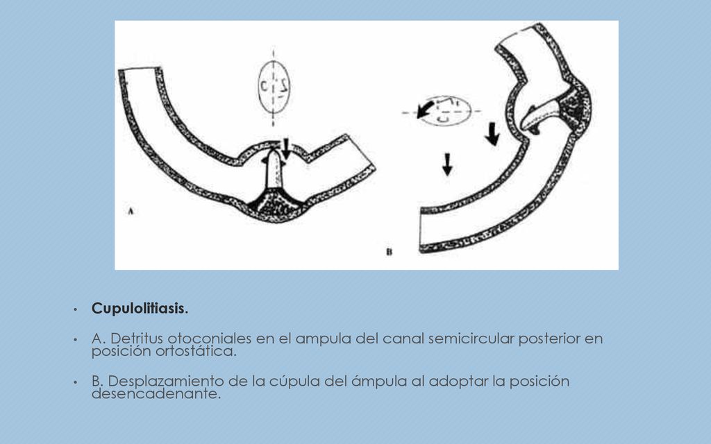Cupulolitiasis. A. Detritus otoconiales en el ampula del canal semicircular posterior en posición ortostática.