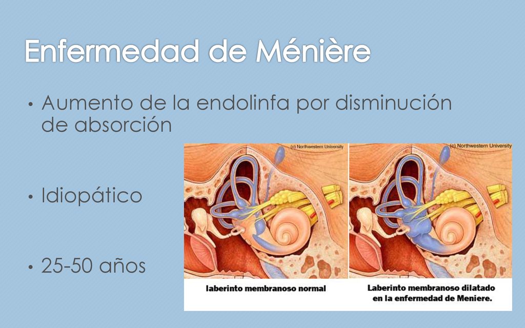 Enfermedad de Ménière Aumento de la endolinfa por disminución de absorción Idiopático años