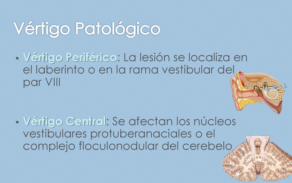 Vértigo Patológico Vértigo Periférico: La lesión se localiza en el laberinto o en la rama vestibular del par VIII.