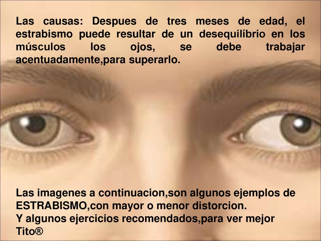 Las causas: Despues de tres meses de edad, el estrabismo puede resultar de un desequilíbrio en los músculos los ojos, se debe trabajar acentuadamente,para superarlo.