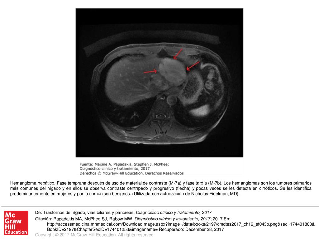 Hemangioma hepático. Fase temprana después de uso de material de contraste (M-7a) y fase tardía (M-7b). Los hemangiomas son los tumores primarios más comunes del hígado y en ellos se observa contraste centrípedo y progresivo (flecha) y pocas veces se les detecta en cirróticos. Se les identifica predominantemente en mujeres y por lo común son benignos. (Utilizada con autorización de Nicholas Fidelman, MD).