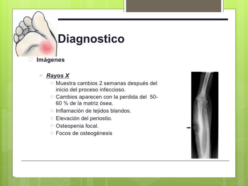 Radiología: No mostrara síntomas óseos hasta pasado 1 o 2 semanas