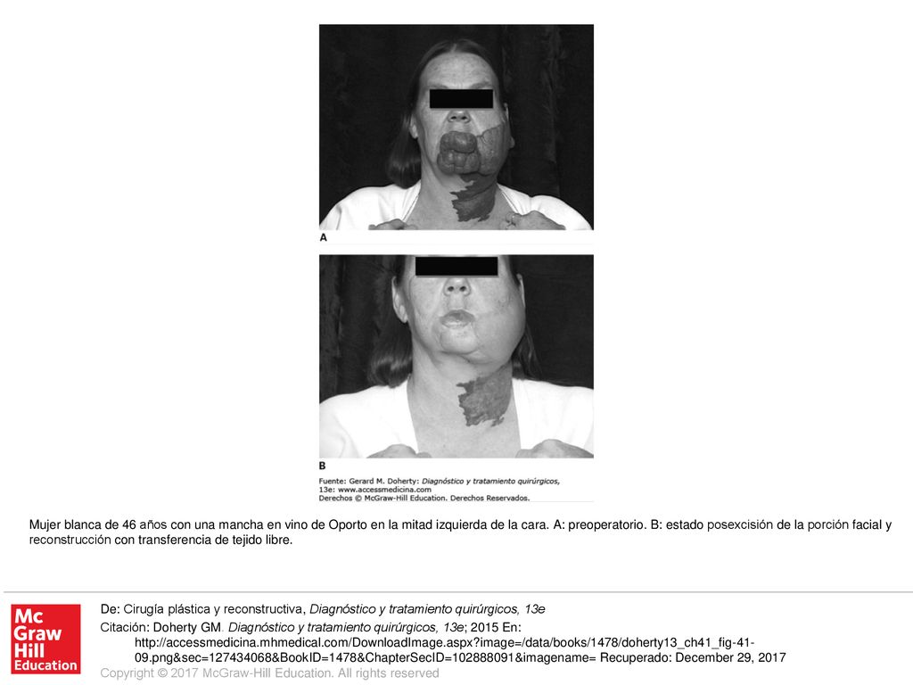 Mujer blanca de 46 años con una mancha en vino de Oporto en la mitad izquierda de la cara. A: preoperatorio. B: estado posexcisión de la porción facial y reconstrucción con transferencia de tejido libre.