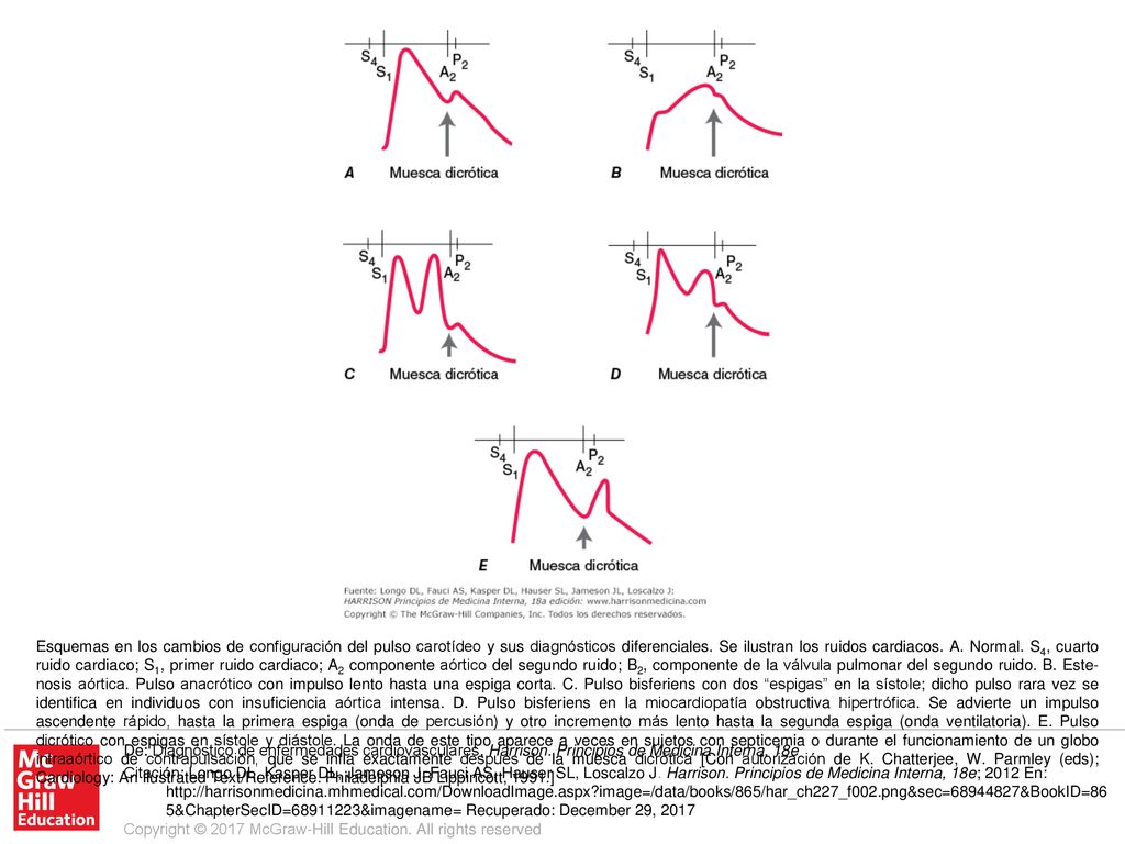 Esquemas en los cambios de configuración del pulso carotídeo y sus diagnósticos diferenciales. Se ilustran los ruidos cardiacos. A. Normal. S4, cuarto ruido cardiaco; S1, primer ruido cardiaco; A2 componente aórtico del segundo ruido; B2, componente de la válvula pulmonar del segundo ruido. B. Este-nosis aórtica. Pulso anacrótico con impulso lento hasta una espiga corta. C. Pulso bisferiens con dos espigas en la sístole; dicho pulso rara vez se identifica en individuos con insuficiencia aórtica intensa. D. Pulso bisferiens en la miocardiopatía obstructiva hipertrófica. Se advierte un impulso ascendente rápido, hasta la primera espiga (onda de percusión) y otro incremento más lento hasta la segunda espiga (onda ventilatoria). E. Pulso dicrótico con espigas en sístole y diástole. La onda de este tipo aparece a veces en sujetos con septicemia o durante el funcionamiento de un globo intraaórtico de contrapulsación, que se infla exactamente después de la muesca dicrótica [Con autorización de K. Chatterjee, W. Parmley (eds); Cardiology: An Ilustrated Text/Reference. Philadelphia JB Lippincott, 1991.]