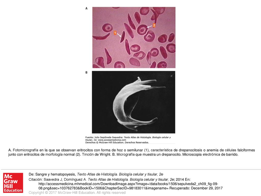 A. Fotomicrografía en la que se observan eritrocitos con forma de hoz o semilunar (1), característica de drepanocitosis o anemia de células falciformes junto con eritrocitos de morfología normal (2). Tinción de Wright. B. Micrografía que muestra un drepanocito. Microscopia electrónica de barrido.