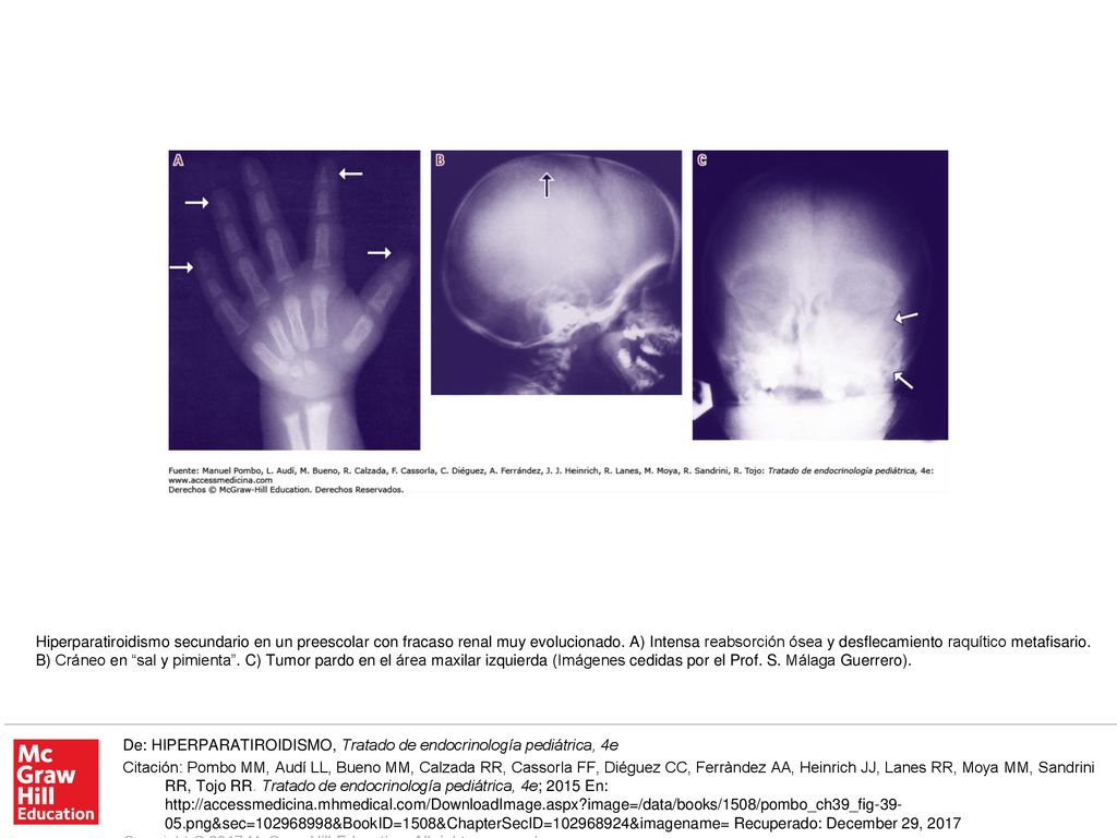 Hiperparatiroidismo secundario en un preescolar con fracaso renal muy evolucionado. A) Intensa reabsorción ósea y desflecamiento raquítico metafisario. B) Cráneo en sal y pimienta . C) Tumor pardo en el área maxilar izquierda (Imágenes cedidas por el Prof. S. Málaga Guerrero).