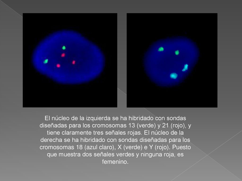 El núcleo de la izquierda se ha hibridado con sondas diseñadas para los cromosomas 13 (verde) y 21 (rojo), y tiene claramente tres señales rojas.