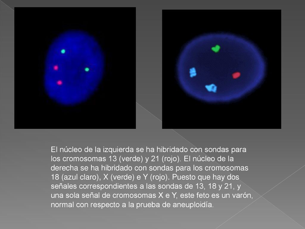 El núcleo de la izquierda se ha hibridado con sondas para los cromosomas 13 (verde) y 21 (rojo).