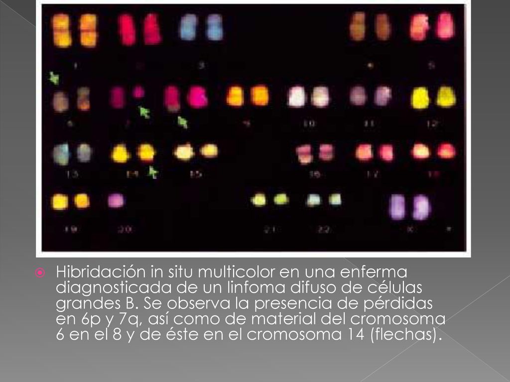 Hibridación in situ multicolor en una enferma diagnosticada de un linfoma difuso de células grandes B.