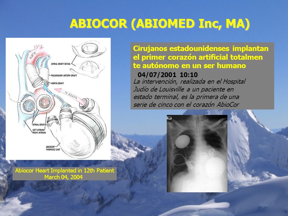 Abiocor Heart Implanted in 12th Patient March 04, 2004