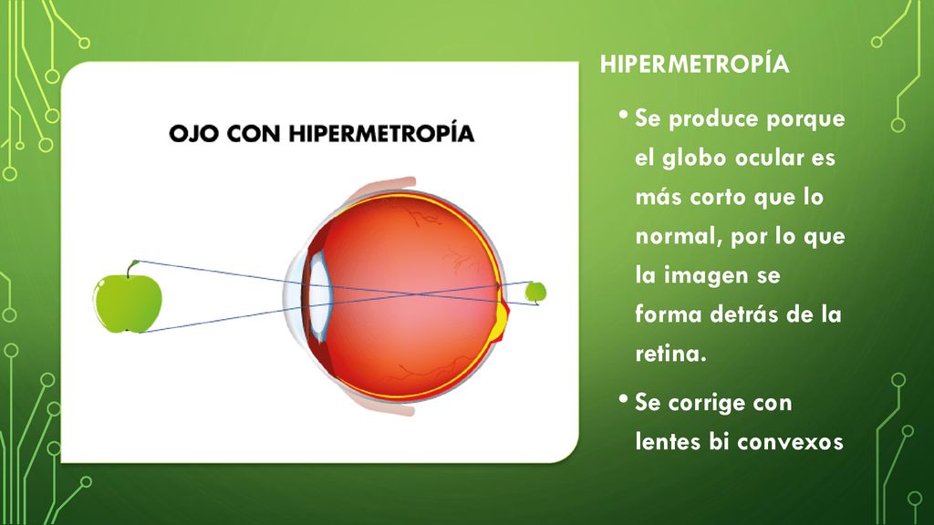 Hipermetropía Se produce porque el globo ocular es más corto que lo normal, por lo que la imagen se forma detrás de la retina.