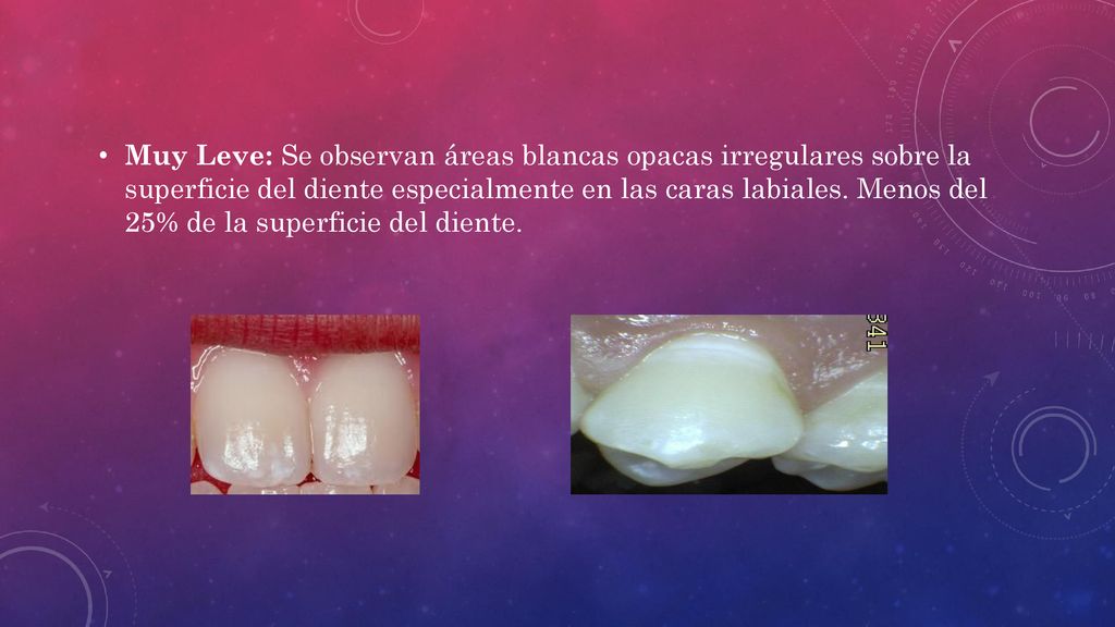 Muy Leve: Se observan áreas blancas opacas irregulares sobre la superficie del diente especialmente en las caras labiales.