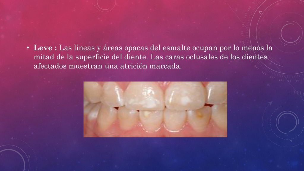 Leve : Las líneas y áreas opacas del esmalte ocupan por lo menos la mitad de la superficie del diente.