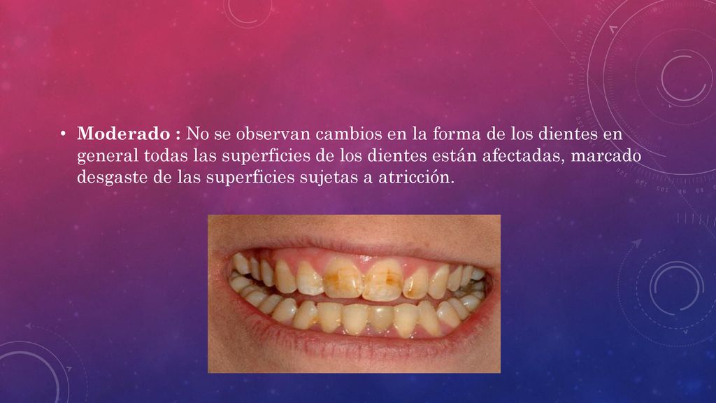 Moderado : No se observan cambios en la forma de los dientes en general todas las superficies de los dientes están afectadas, marcado desgaste de las superficies sujetas a atricción.