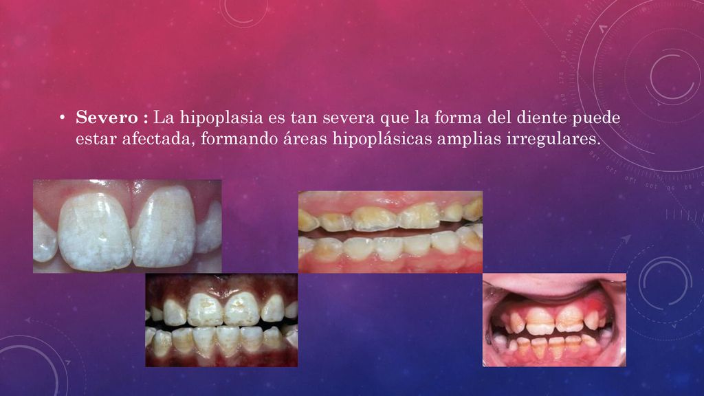 Severo : La hipoplasia es tan severa que la forma del diente puede estar afectada, formando áreas hipoplásicas amplias irregulares.