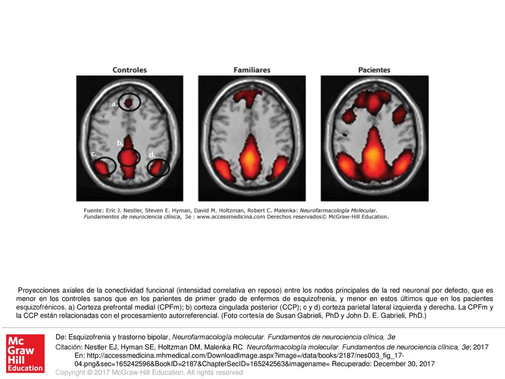Proyecciones axiales de la conectividad funcional (intensidad correlativa en reposo) entre los nodos principales de la red neuronal por defecto, que es menor en los controles sanos que en los parientes de primer grado de enfermos de esquizofrenia, y menor en estos últimos que en los pacientes esquizofrénicos. a) Corteza prefrontal medial (CPFm); b) corteza cingulada posterior (CCP); c y d) corteza parietal lateral izquierda y derecha. La CPFm y la CCP están relacionadas con el procesamiento autorreferencial. (Foto cortesía de Susan Gabrieli, PhD y John D. E. Gabrieli, PhD.)