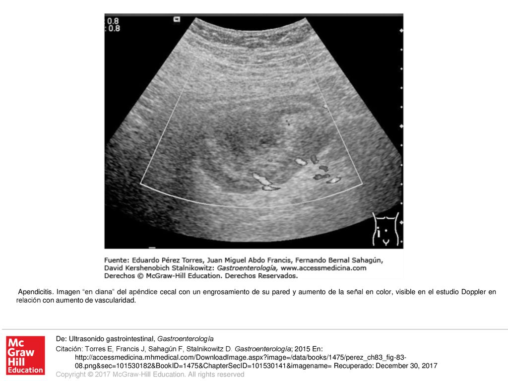 Apendicitis. Imagen en diana del apéndice cecal con un engrosamiento de su pared y aumento de la señal en color, visible en el estudio Doppler en relación con aumento de vascularidad.