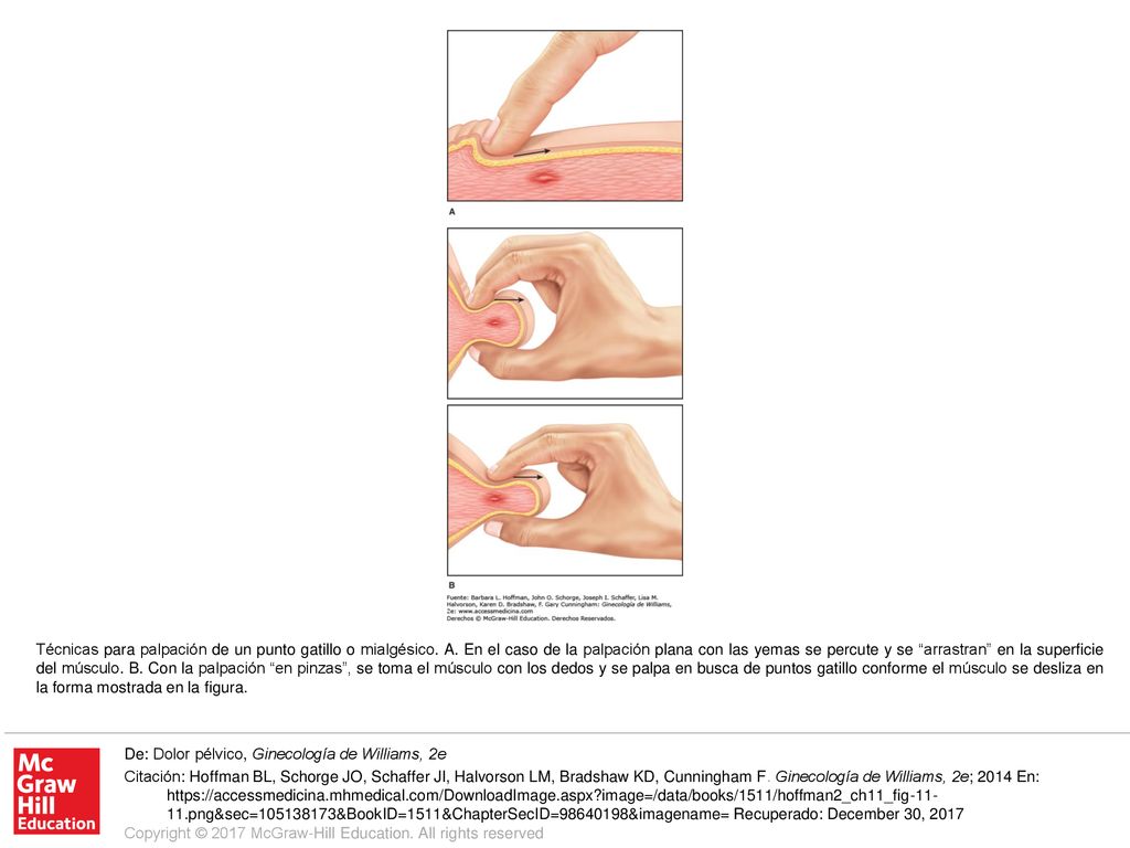 Técnicas para palpación de un punto gatillo o mialgésico. A