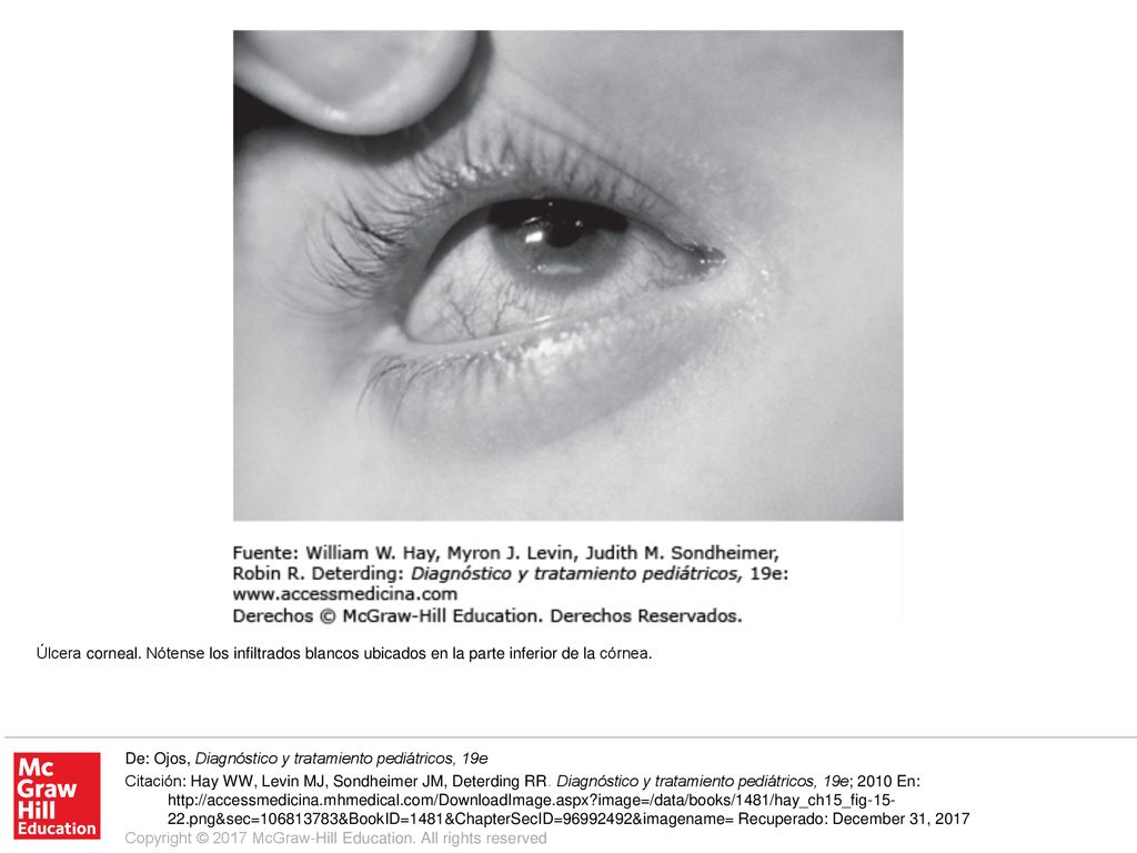 Úlcera corneal. Nótense los infiltrados blancos ubicados en la parte inferior de la córnea.