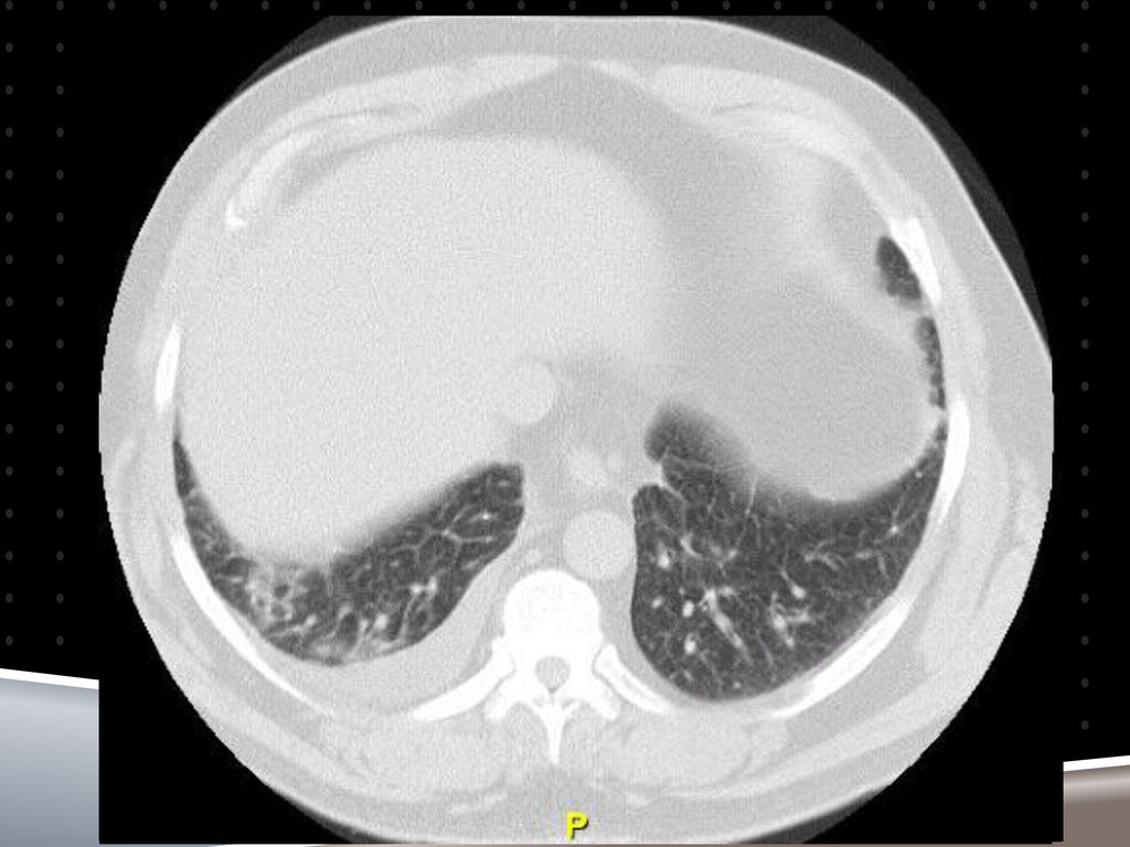 TC Tórax: - Perdida de la arquitectura pulmonar con engrosamiento del intesticio central y periférico, de aspecto fibrótico retractil, que compromete predomintemtnte ambos lóbulos superiores, mas marcado en LSD. - Parches de vidrio esmerilado en ambos campos pulmonares, mas marcado en hemitorax derecho. - Engrosamiento intesticio periférico en ambos lóbulos inferiores - Adenopatias mediastinales múltiples en todos los compatimientos - Engrosamienot pleural (mas predominate en hemitorax dercho) - Enfisema paraseptal en lobulos superiores .