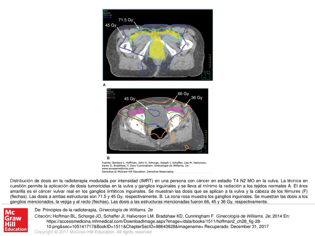 Distribución de dosis en la radioterapia modulada por intensidad (IMRT) en una persona con cáncer en estadio T4 N2 MO en la vulva. La técnica en cuestión permite la aplicación de dosis tumoricidas en la vulva y ganglios inguinales y se lleva al mínimo la radiación a los tejidos normales A. El área amarilla es el cáncer vulvar real en los ganglios linfáticos inguinales. Se muestran las dosis que se aplican a la vulva y la cabeza de los fémures (F) (flechas). Las dosis a ambas estructuras son 71.5 y 45 Gy, respectivamente. B. La zona rosa muestra los ganglios inguinales. Se muestran las dosis a los ganglios mencionados, la vejiga y al recto (flechas). Las dosis a las estructuras mencionadas fueron 66, 45 y 36 Gy, respectivamente.