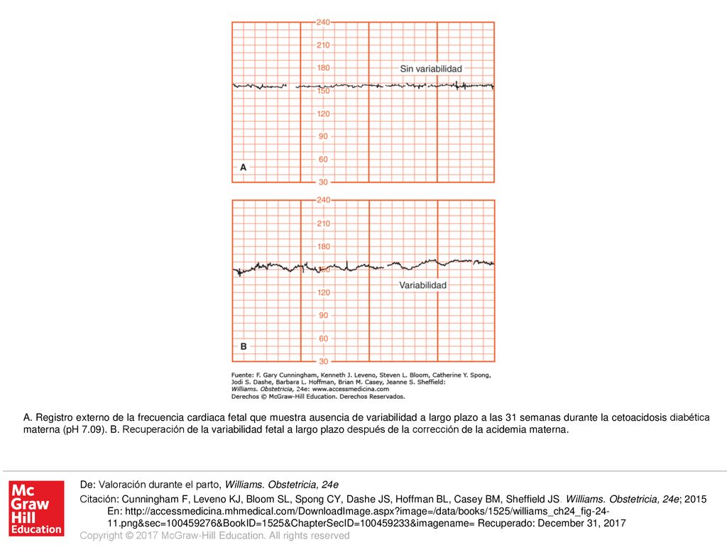 A. Registro externo de la frecuencia cardiaca fetal que muestra ausencia de variabilidad a largo plazo a las 31 semanas durante la cetoacidosis diabética materna (pH 7.09). B. Recuperación de la variabilidad fetal a largo plazo después de la corrección de la acidemia materna.