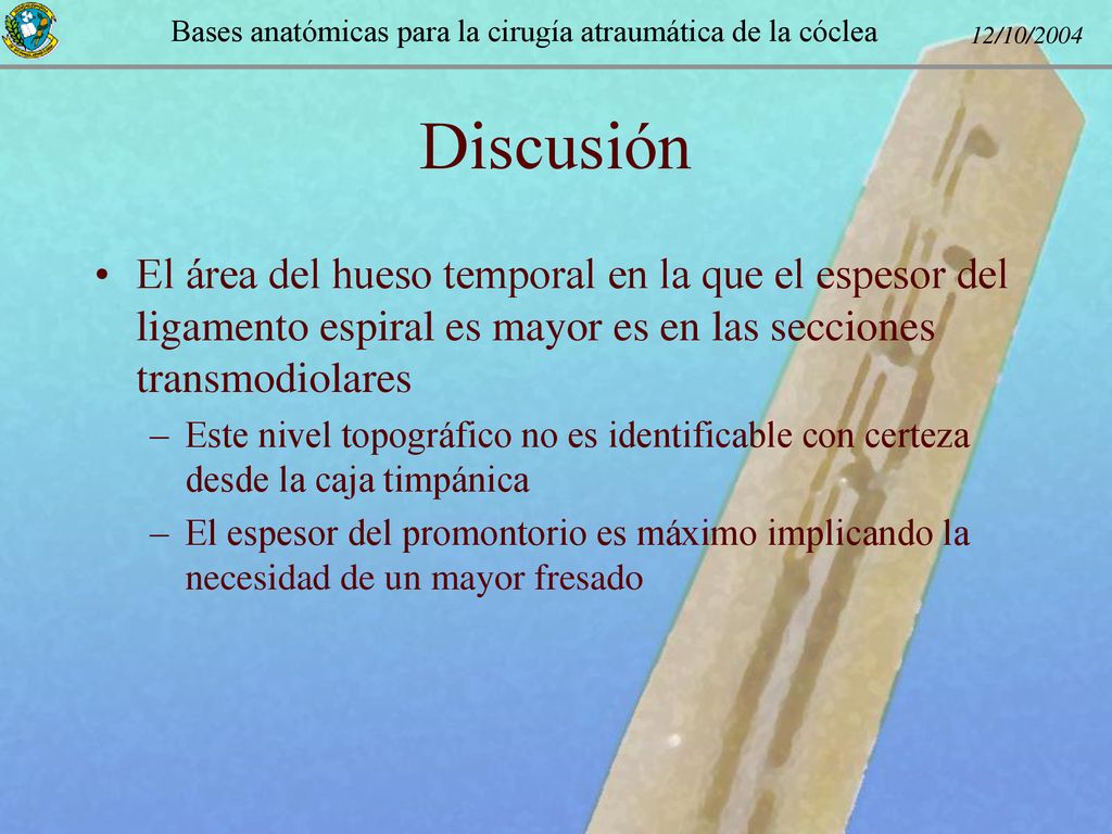 Discusión El área del hueso temporal en la que el espesor del ligamento espiral es mayor es en las secciones transmodiolares.