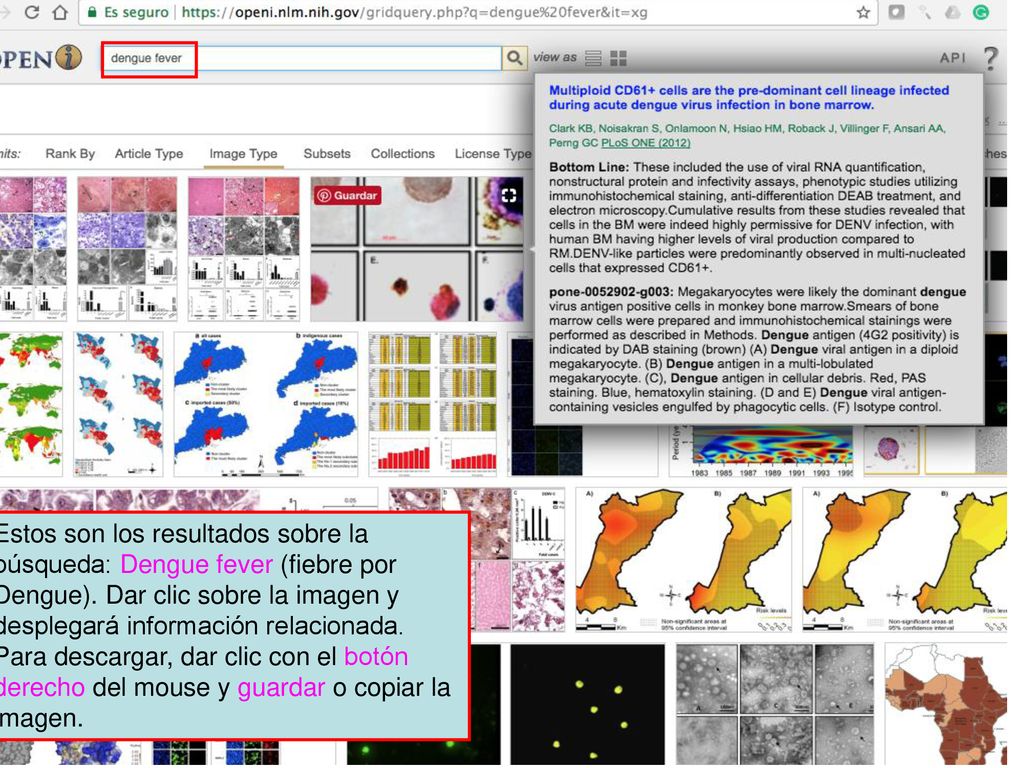 Estos son los resultados sobre la búsqueda: Dengue fever (fiebre por Dengue).