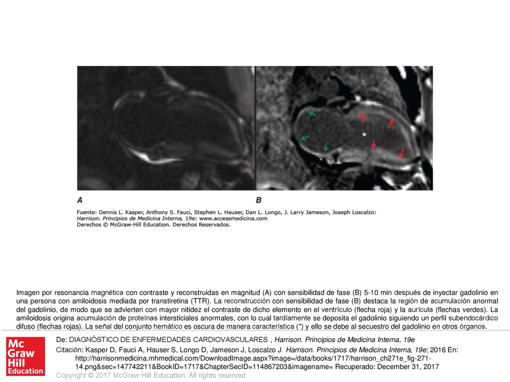 Imagen por resonancia magnética con contraste y reconstruidas en magnitud (A) con sensibilidad de fase (B) 5-10 min después de inyectar gadolinio en una persona con amiloidosis mediada por transtiretina (TTR). La reconstrucción con sensibilidad de fase (B) destaca la región de acumulación anormal del gadolinio, de modo que se advierten con mayor nitidez el contraste de dicho elemento en el ventrículo (flecha roja) y la aurícula (flechas verdes). La amiloidosis origina acumulación de proteínas intersticiales anormales, con lo cual tardíamente se deposita el gadolinio siguiendo un perfil subendocárdico difuso (flechas rojas). La señal del conjunto hemático es oscura de manera característica (*) y ello se debe al secuestro del gadolinio en otros órganos.