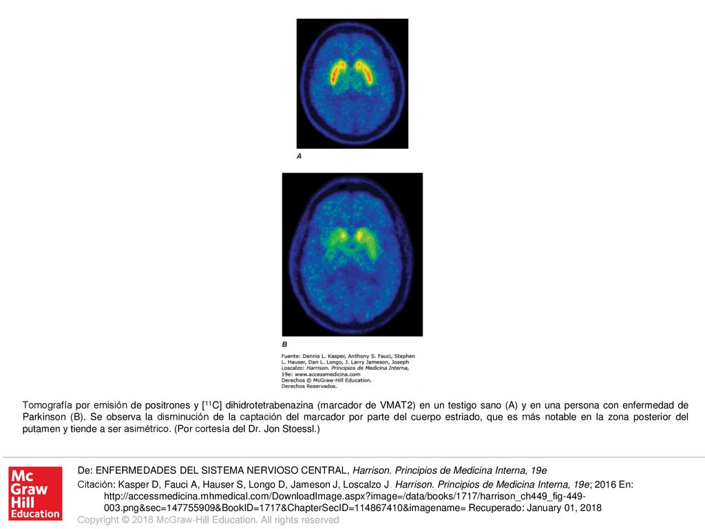 Tomografía por emisión de positrones y [11C] dihidrotetrabenazina (marcador de VMAT2) en un testigo sano (A) y en una persona con enfermedad de Parkinson (B). Se observa la disminución de la captación del marcador por parte del cuerpo estriado, que es más notable en la zona posterior del putamen y tiende a ser asimétrico. (Por cortesía del Dr. Jon Stoessl.)