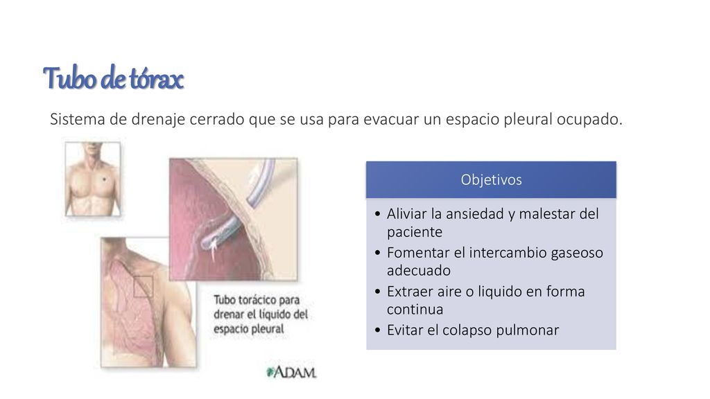 Tubo de tórax Sistema de drenaje cerrado que se usa para evacuar un espacio pleural ocupado. Objetivos.