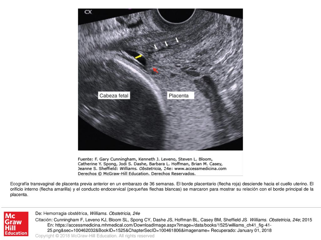 Ecografía transvaginal de placenta previa anterior en un embarazo de 36 semanas. El borde placentario (flecha roja) desciende hacia el cuello uterino. El orificio interno (flecha amarilla) y el conducto endocervical (pequeñas flechas blancas) se marcaron para mostrar su relación con el borde principal de la placenta.