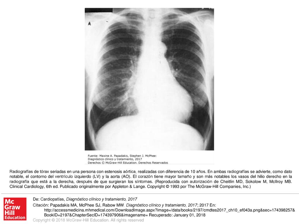Radiografías de tórax seriadas en una persona con estenosis aórtica, realizadas con diferencia de 10 años. En ambas radiografías se advierte, como dato notable, el contorno del ventrículo izquierdo (LV) y la aorta (AO). El corazón tiene mayor tamaño y son más notables los vasos del hilio derecho en la radiografía que está a la derecha, después de que surgieran los síntomas. (Reproducida con autorización de Cheitlin MD, Sokolow M, McIlroy MB. Clinical Cardiology, 6th ed. Publicado originalmente por Appleton & Lange. Copyright © 1993 por The McGraw-Hill Companies, Inc.)