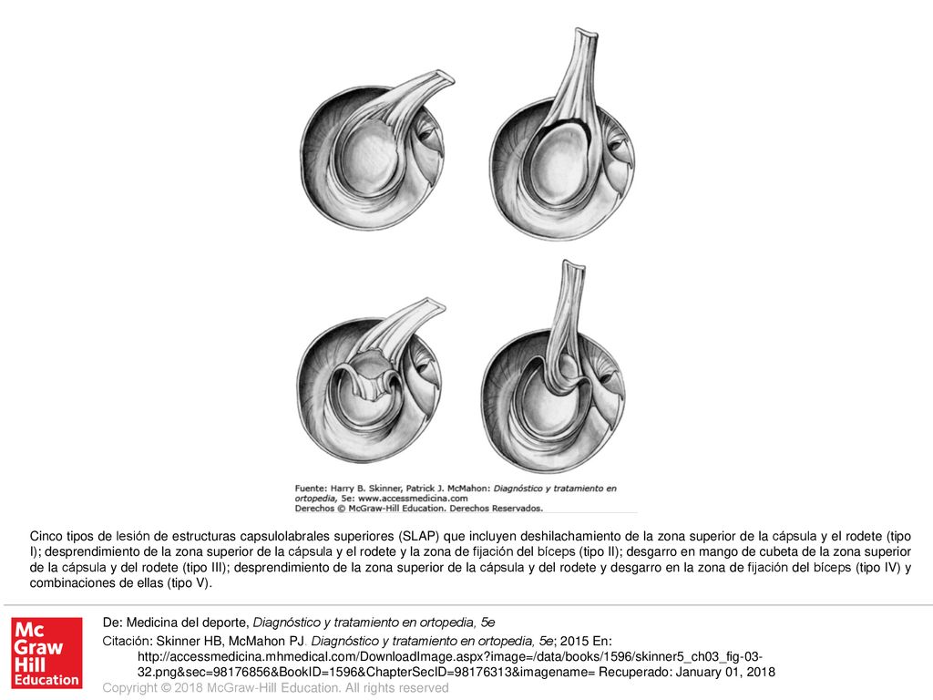 Cinco tipos de lesión de estructuras capsulolabrales superiores (SLAP) que incluyen deshilachamiento de la zona superior de la cápsula y el rodete (tipo I); desprendimiento de la zona superior de la cápsula y el rodete y la zona de fijación del bíceps (tipo II); desgarro en mango de cubeta de la zona superior de la cápsula y del rodete (tipo III); desprendimiento de la zona superior de la cápsula y del rodete y desgarro en la zona de fijación del bíceps (tipo IV) y combinaciones de ellas (tipo V).