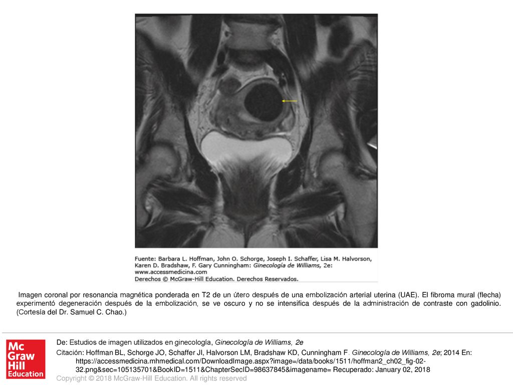 Imagen coronal por resonancia magnética ponderada en T2 de un útero después de una embolización arterial uterina (UAE). El fibroma mural (flecha) experimentó degeneración después de la embolización, se ve oscuro y no se intensifica después de la administración de contraste con gadolinio. (Cortesía del Dr. Samuel C. Chao.)