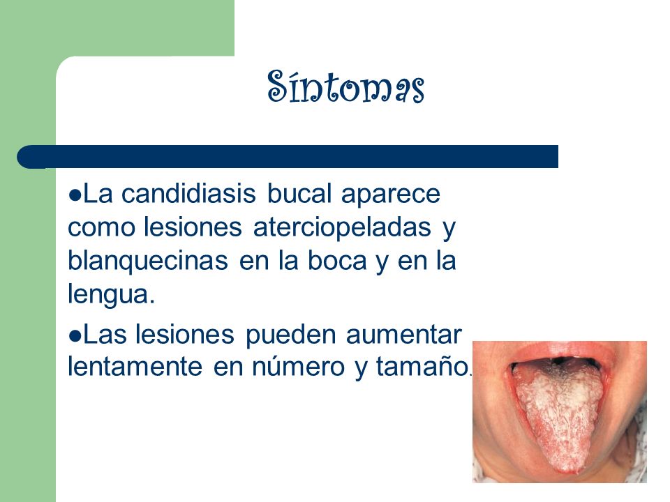 Síntomas La candidiasis bucal aparece como lesiones aterciopeladas y blanquecinas en la boca y en la lengua.