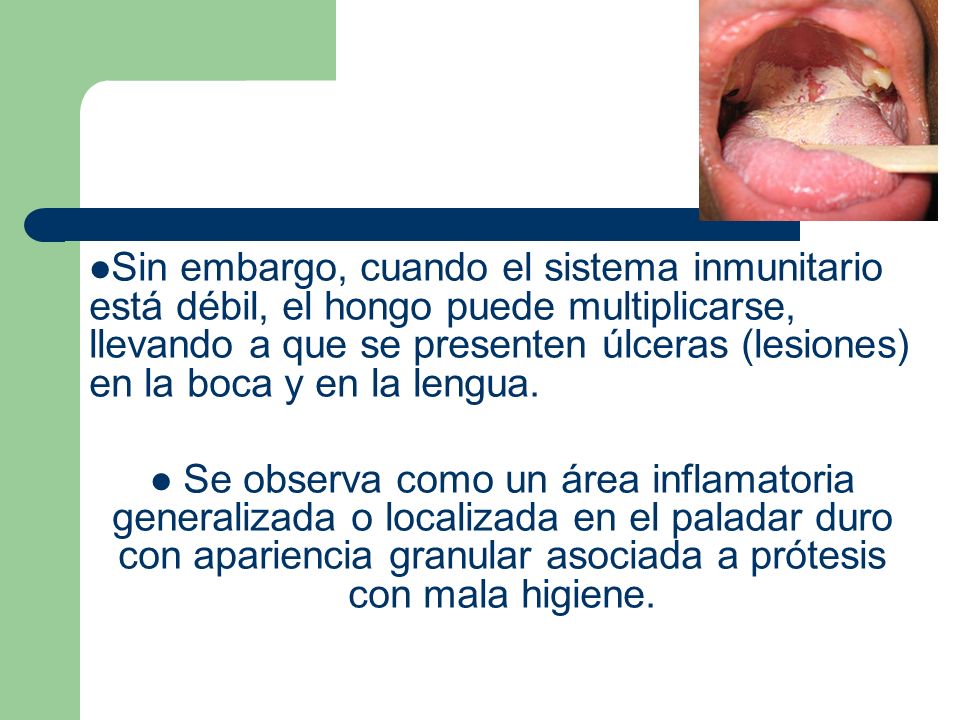 Sin embargo, cuando el sistema inmunitario está débil, el hongo puede multiplicarse, llevando a que se presenten úlceras (lesiones) en la boca y en la lengua.