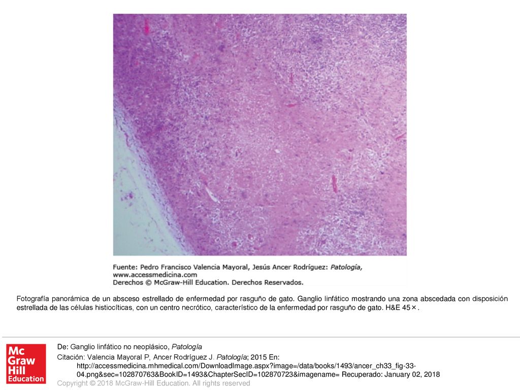 Fotografía panorámica de un absceso estrellado de enfermedad por rasguño de gato. Ganglio linfático mostrando una zona abscedada con disposición estrellada de las células histiocíticas, con un centro necrótico, característico de la enfermedad por rasguño de gato. H&E 45×.