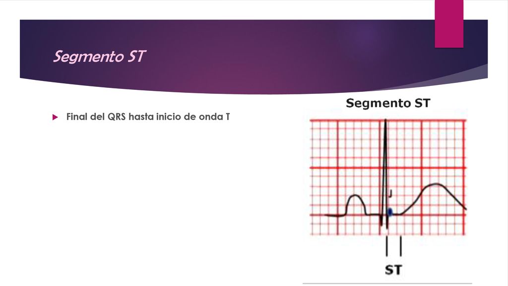 Segmento ST Final del QRS hasta inicio de onda T