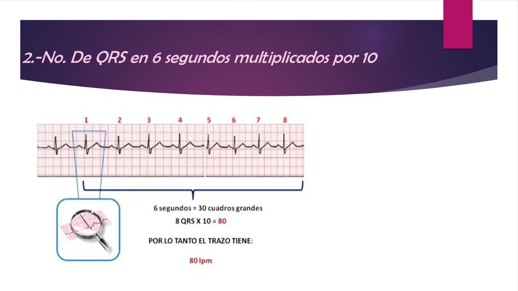 2.-No. De QRS en 6 segundos multiplicados por 10