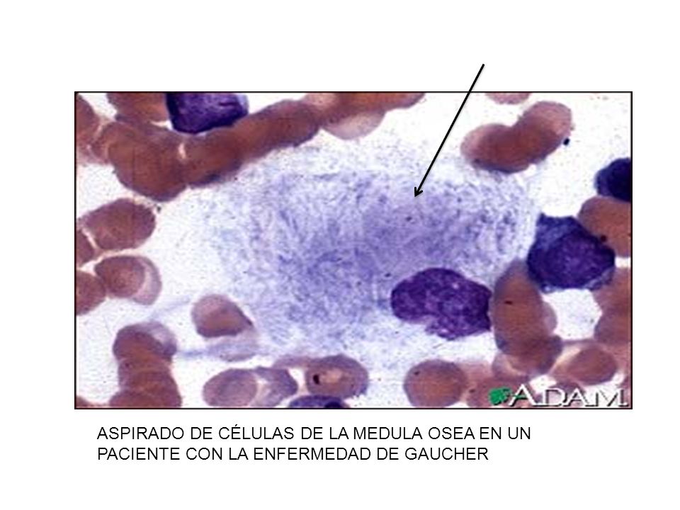ASPIRADO DE CÉLULAS DE LA MEDULA OSEA EN UN PACIENTE CON LA ENFERMEDAD DE GAUCHER