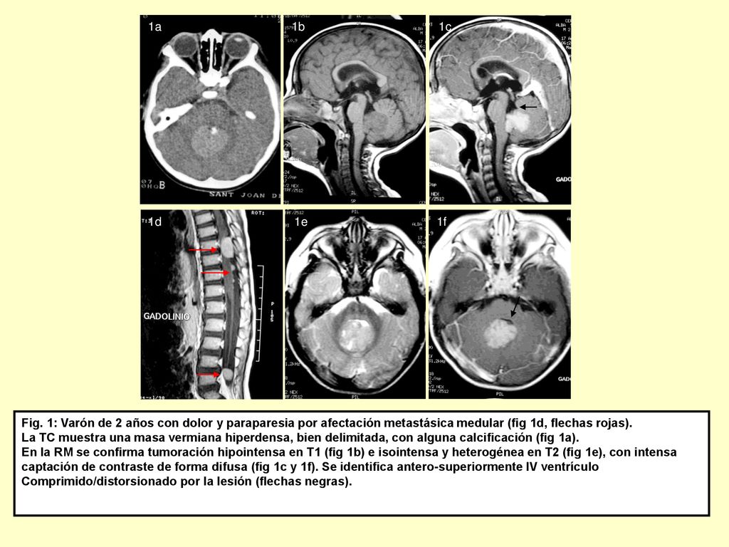 1a 1b. 1d. 1e. 1f. 1c. 1a. Fig. 1: Varón de 2 años con dolor y paraparesia por afectación metastásica medular (fig 1d, flechas rojas).