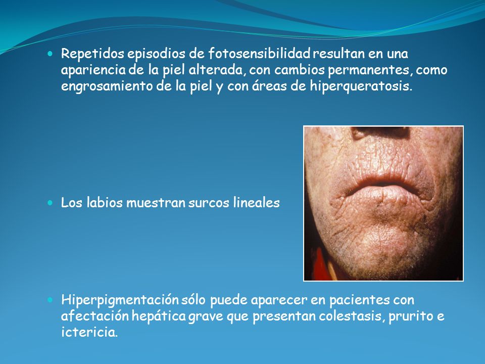 Repetidos episodios de fotosensibilidad resultan en una apariencia de la piel alterada, con cambios permanentes, como engrosamiento de la piel y con áreas de hiperqueratosis.