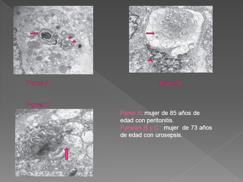 Panel A Panel B Panel C Panel A: mujer de 85 años de edad con peritonitis.