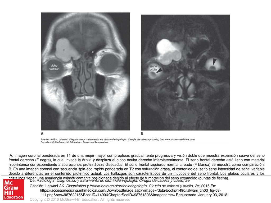 A. Imagen coronal ponderada en T1 de una mujer mayor con proptosis gradualmente progresiva y visión doble que muestra expansión suave del seno frontal derecho (F negra), la cual invade la órbita y desplaza el globo ocular derecho inferolateralmente. El seno frontal derecho está lleno con material hiperintenso correspondiente a secreciones proteináceas disecadas. El seno frontal izquierdo normal aireado (F blanca) se muestra como comparación. B. En una imagen coronal con secuencia spin-eco rápido ponderada en T2 con saturación grasa, el contenido del seno tiene intensidad de señal variable debido a diferencias en el contenido proteínico actual. Los hallazgos son característicos de un mucocele del seno frontal. Los globos oculares y los cristalinos tienen una apariencia asimétricamente posicionada debido al efecto de tumoración del seno expandido (puntas de flecha).