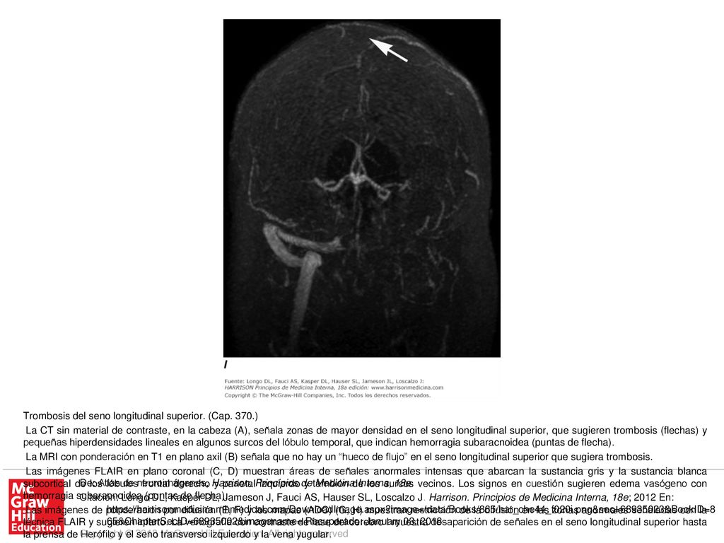 Imágenes en plano axil (J) y coronal (K) con ponderación en T1 después de administrar gadolinio en que se observa un defecto de llenado en el seno longitudinal superior, que sugiere trombosis.
