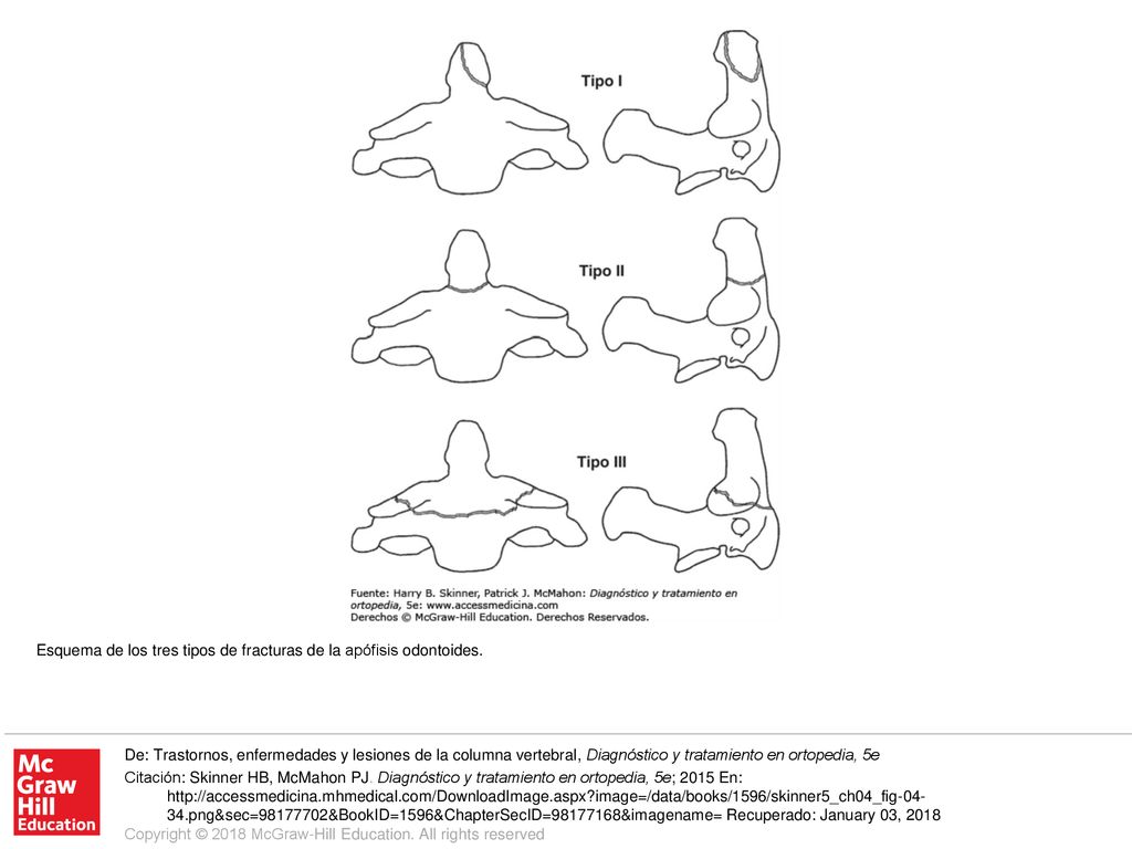 Esquema de los tres tipos de fracturas de la apófisis odontoides.